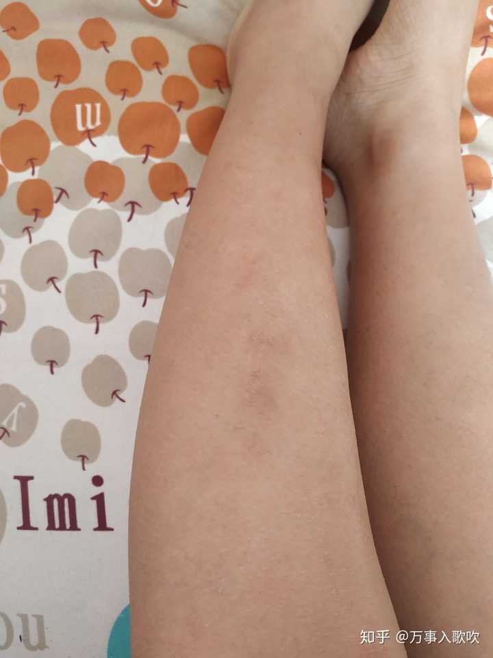 患有寻常型鱼鳞病的女生是一种什么体验?