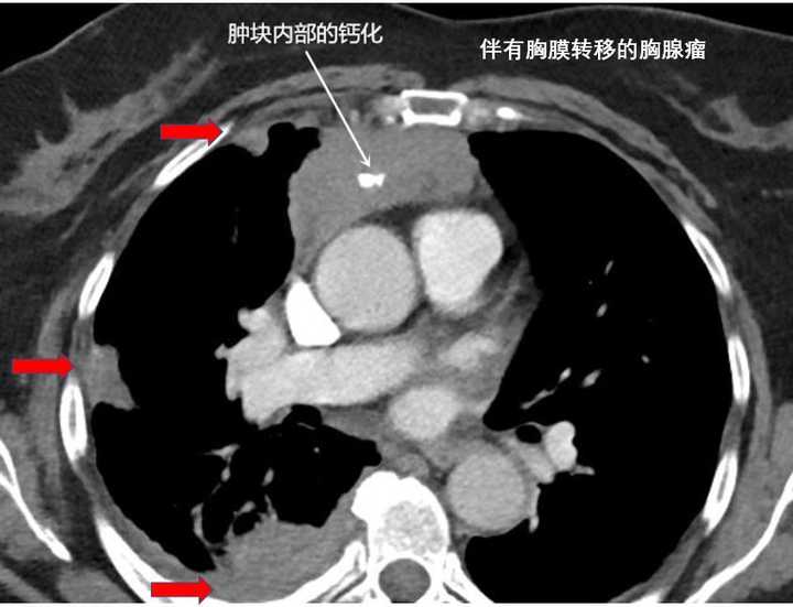 增强ct是否能判断胸腺瘤是良性还是恶性的?