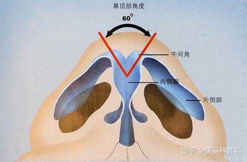 除了单纯的鼻头软组织肥厚造成鼻头不好看,鼻翼软骨角度也在影响鼻头