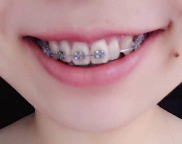 25 岁后去矫正牙齿(带牙套)是什么体验?