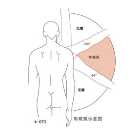 肩峰撞击综合症怎么办?