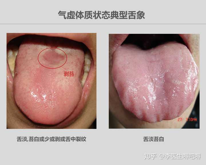 李医生的临床经验是以 舌脉象为主,以症状为辅判断气虚最为准确.