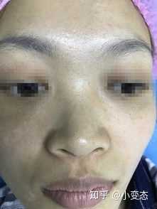 拥有宽鼻翼大鼻头是怎样一种体验?