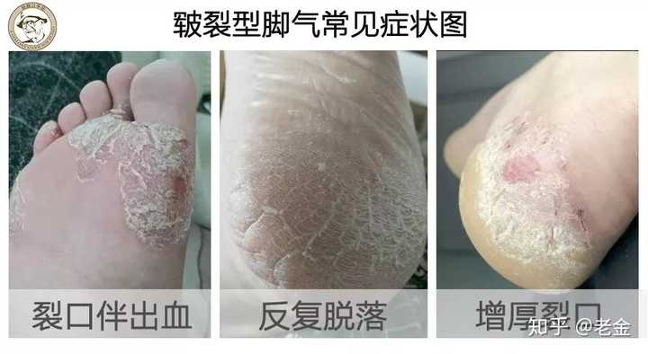 脚气脚气怎么治才能除根?