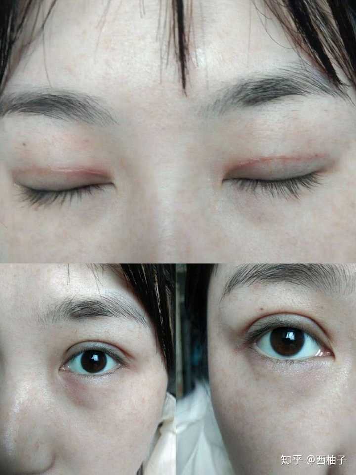 割双眼皮是种怎样的体验?