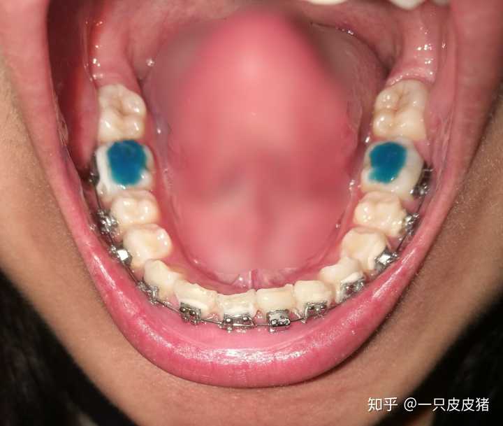 深覆合是什么?有什么危害?