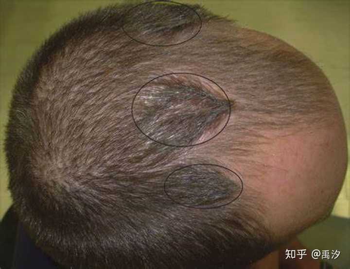 我猜你止不住挠挠头,又挠出几片头皮屑下来.