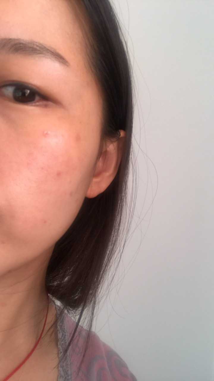 二氧化碳激光点痣后的红印多久消失?