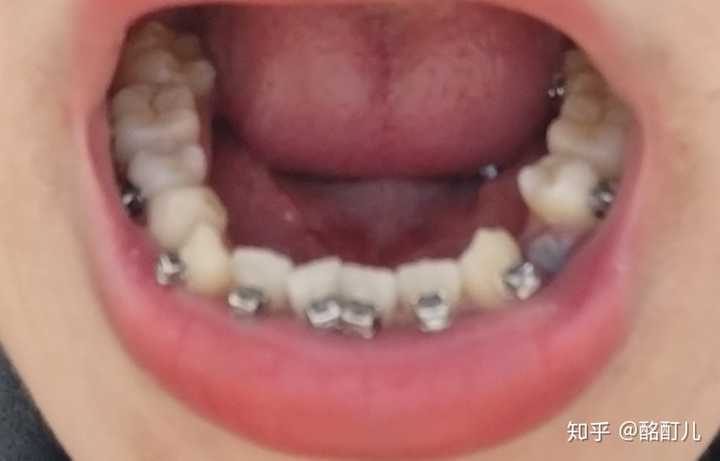 拔牙3天后,牙窟窿上有了白色的膜.舌侧的一个牙片可以被看到
