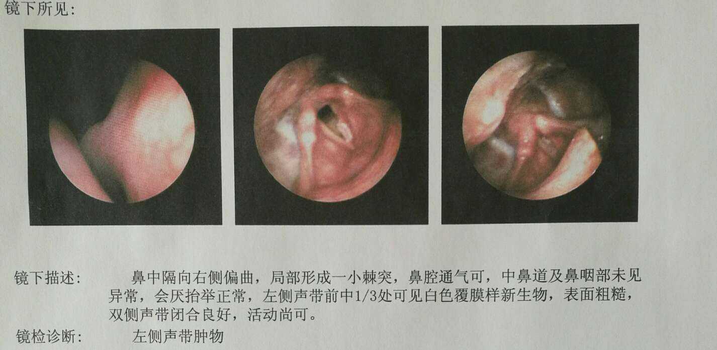 耳鼻咽喉杨医生 的想法 一个早期声带癌患者,主要表现为声音嘶哑