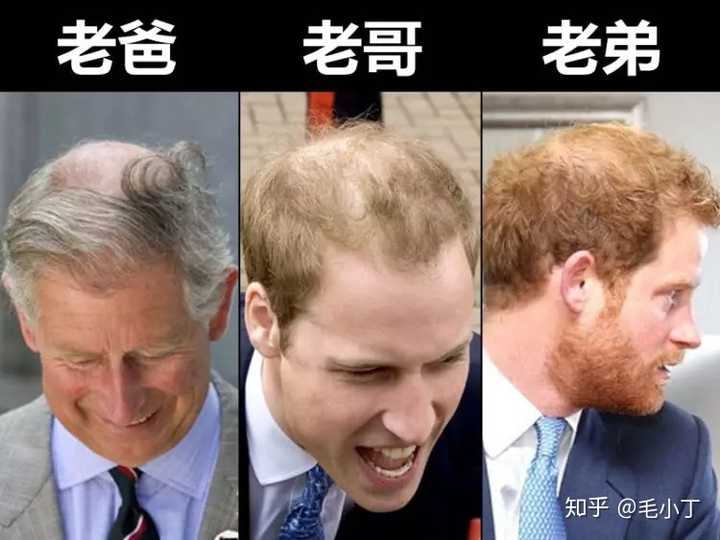 怎么看待英国威廉王子脱发这个事?