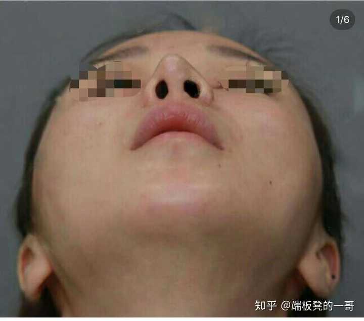 隆鼻失败之后是怎么样的?