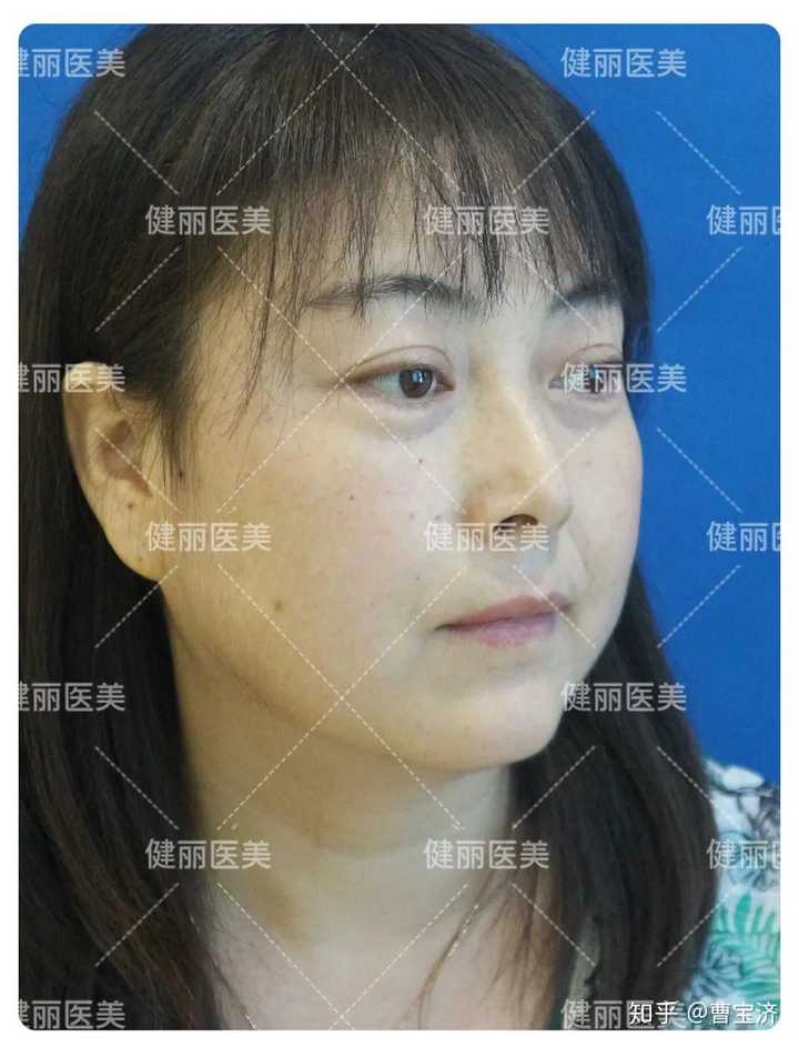 有什么习惯或者小方法能使眼袋慢慢变成卧蚕?