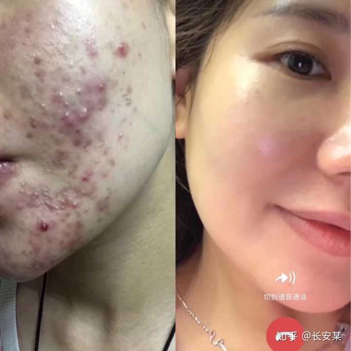 脸上长痘痘反反复复,该怎么办?