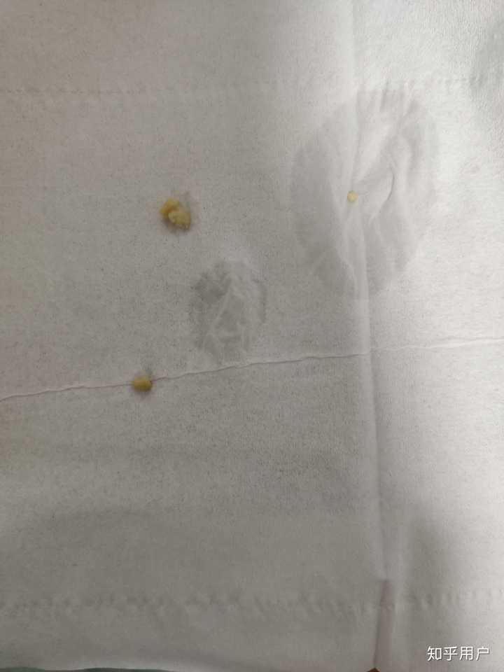 扁桃腺结石怎么清理?