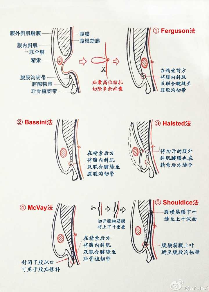 无张力疝修补术 两种术式都是先做疝囊高位结扎,但传统使用手工缝合