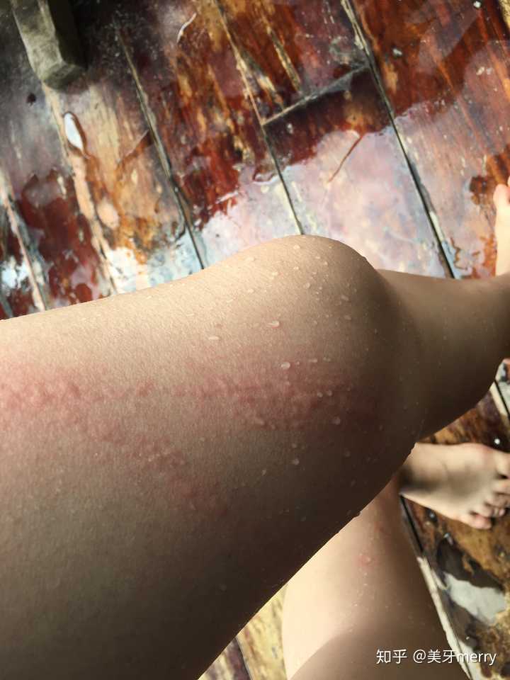 被水母蛰是一种什么体验?