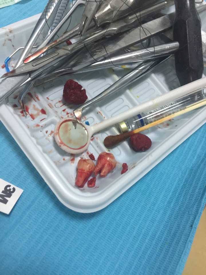 所以真的不喜欢 拔牙