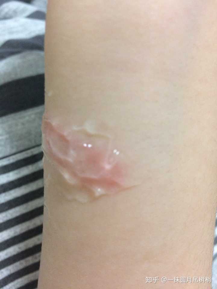 giao!被烫的地方红红的还很痛.所以我有了以下操作.