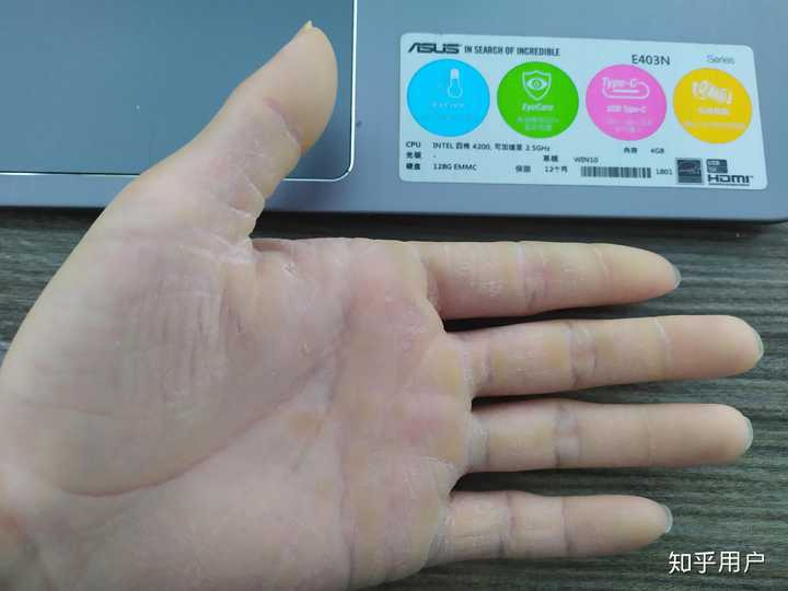 先天性就有掌跖角化症 而且很严重 有心理障碍?