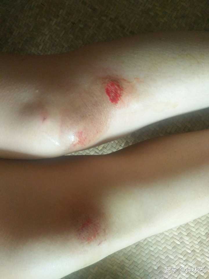 骑车摔伤后,膝盖留疤了.