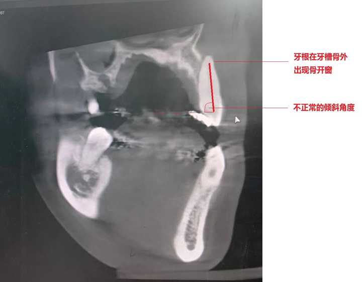 骨开窗