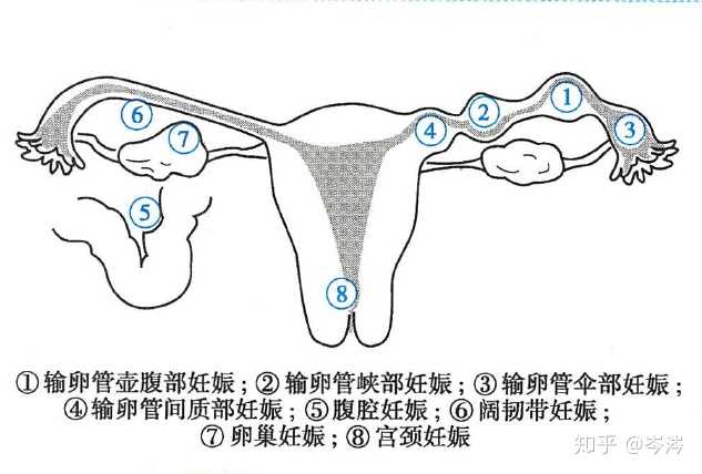 是否能再次怀孕,这里讲再次异位妊娠,还是宫内妊娠都叫怀孕啊, 都是有