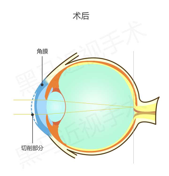 激光手术矫正视力对眼睛到底有没有伤害?