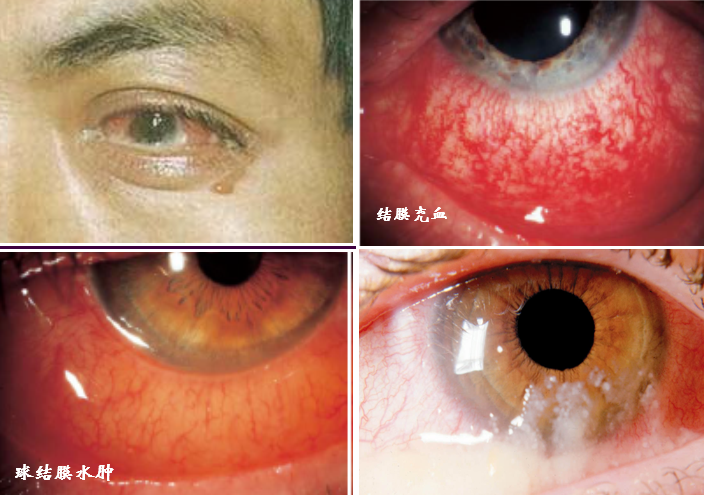 「红眼病」产生的原因是什么,如何预防?