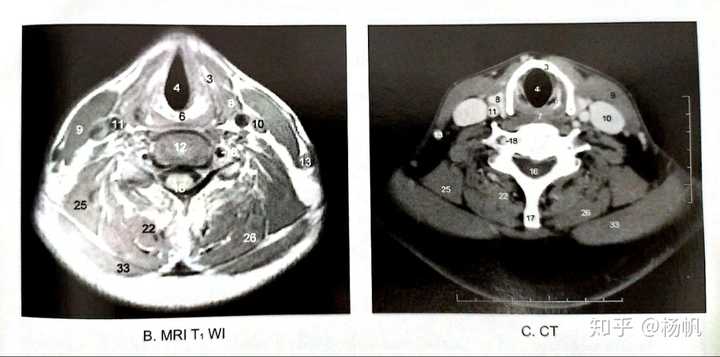 经声襞和环状软骨板的横断扫(左mri,右ct)