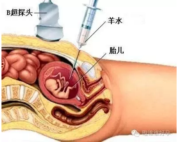 大夫会在b超的引导下,将一根细长的穿刺针穿到子宫里,抽取20-30ml的