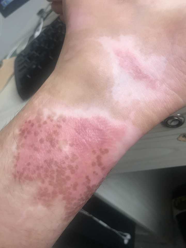 脚背被开水烫伤,诊断为深二度烧伤,已经两个月了,怎样减少疤痕和色素