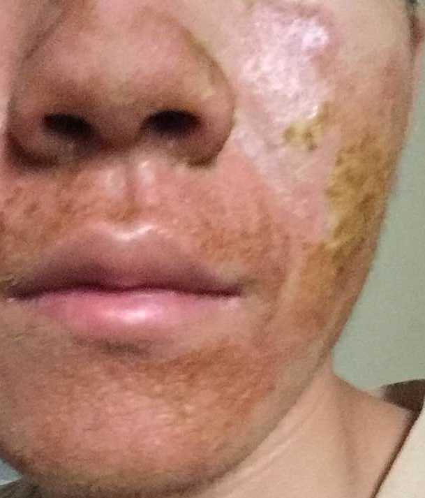 如何治疗脂溢性皮炎?
