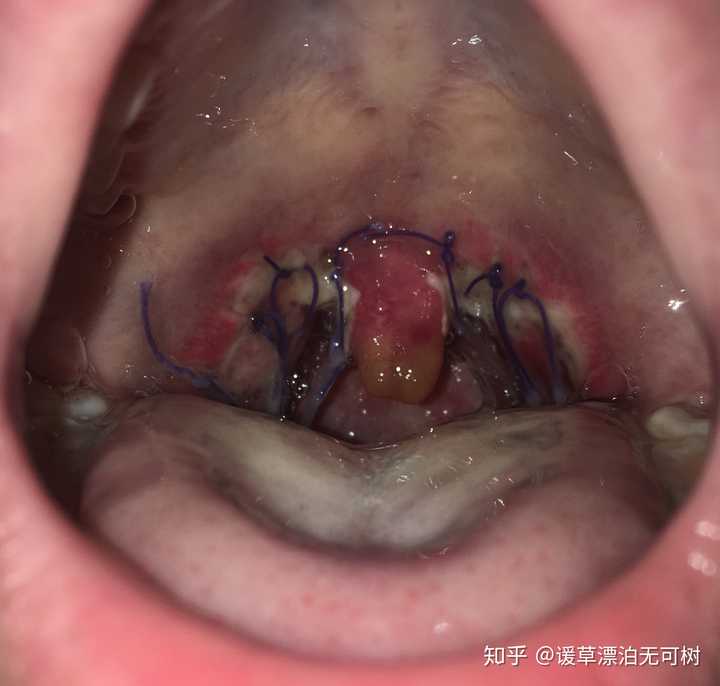 切扁桃体之后是什么感觉?