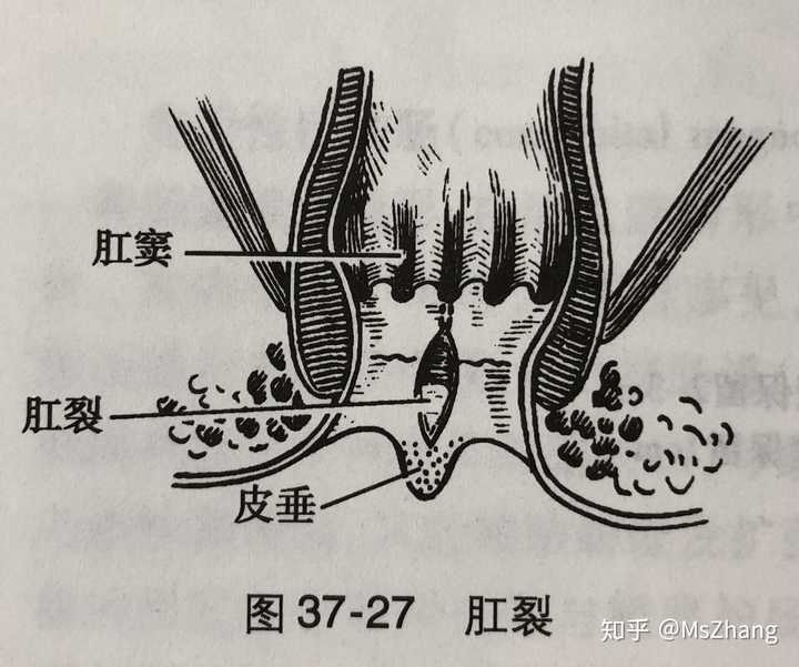 肛裂  