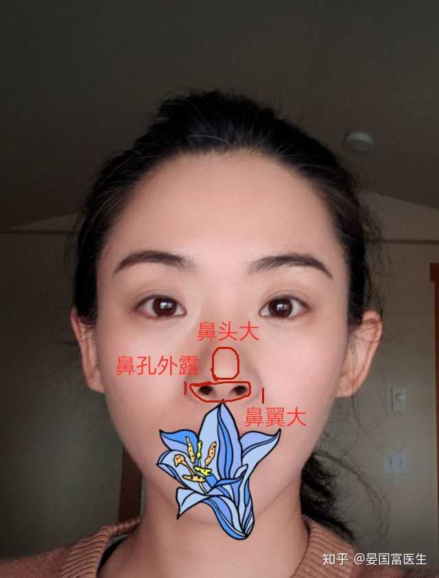 这样的鼻子只做鼻翼缩小,可以吗?