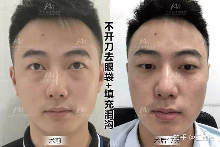 男生眼袋怎么消除?