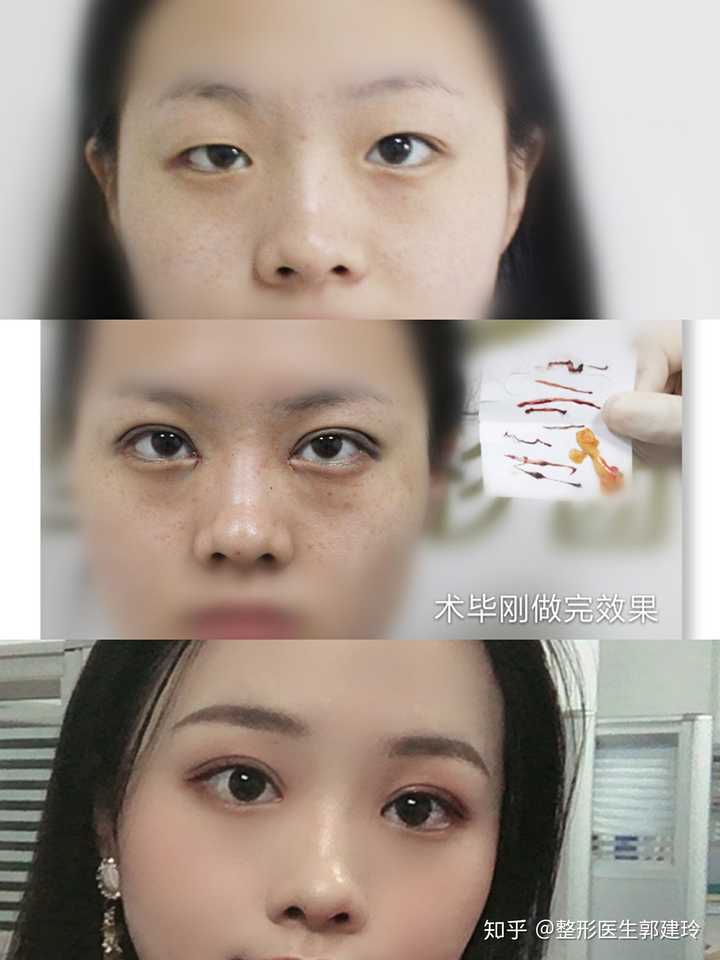怎么从内双恢复外双?