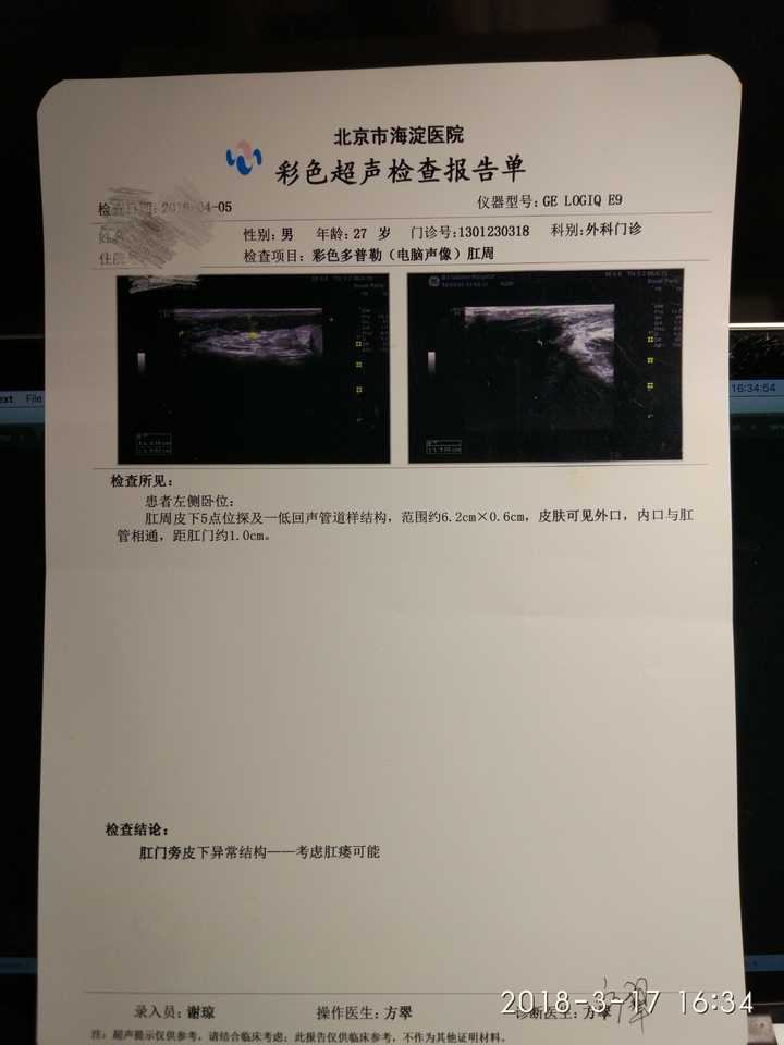 肛瘘手术痛苦吗?多久能康复?