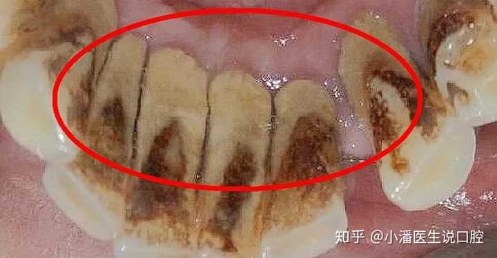 牙结石不去除可以吗?