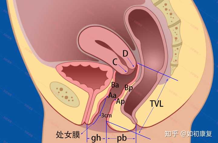 如何理解盆腔器官脱垂的pop-q分度?