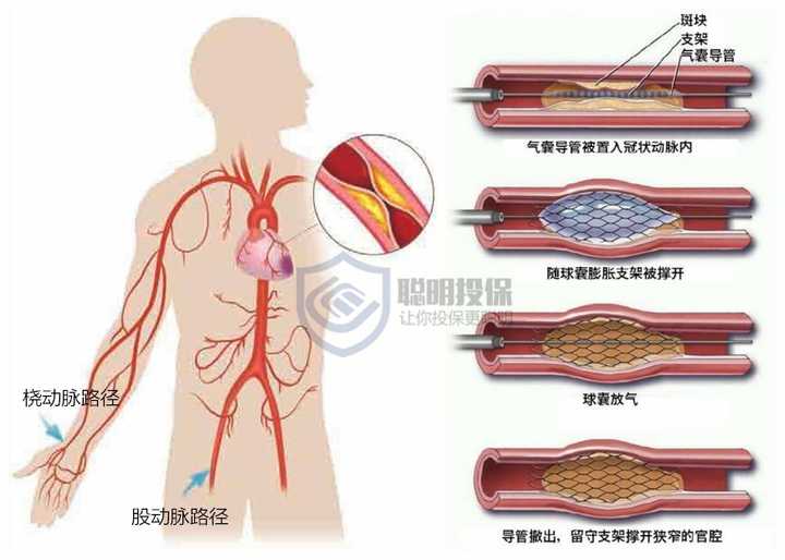 1,股动脉路径:股动脉比较粗大,穿刺成功率高.