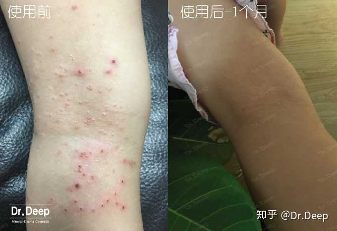 一岁宝宝传染性软疣如何治疗?