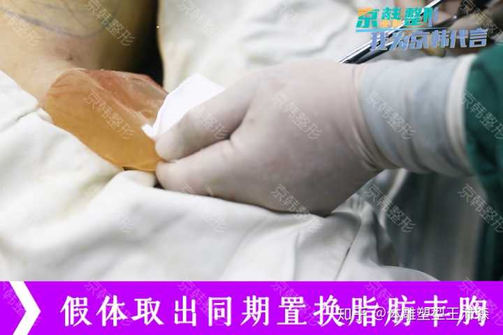 用自体脂肪丰胸会有后遗症吗?