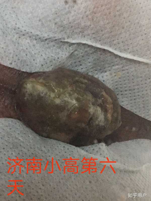 痔疮肉球怎么消除?