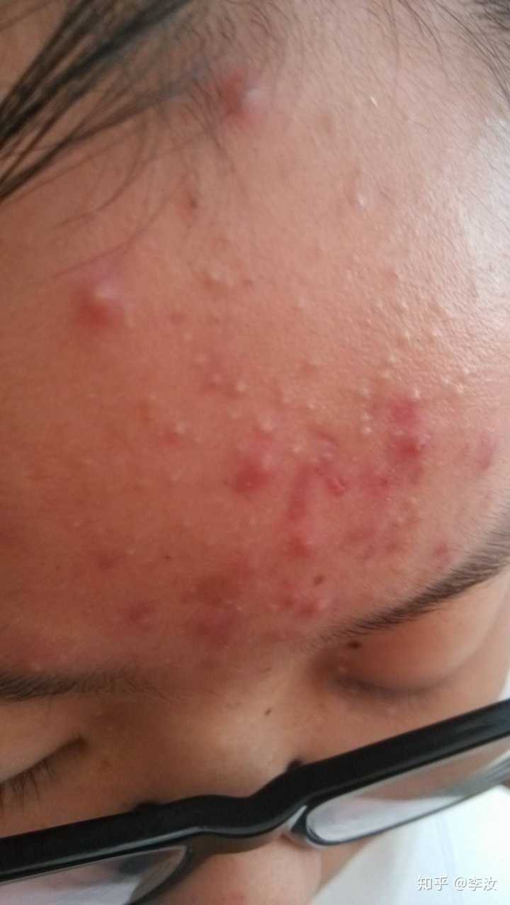 如何有效淡化脸上的痘印?