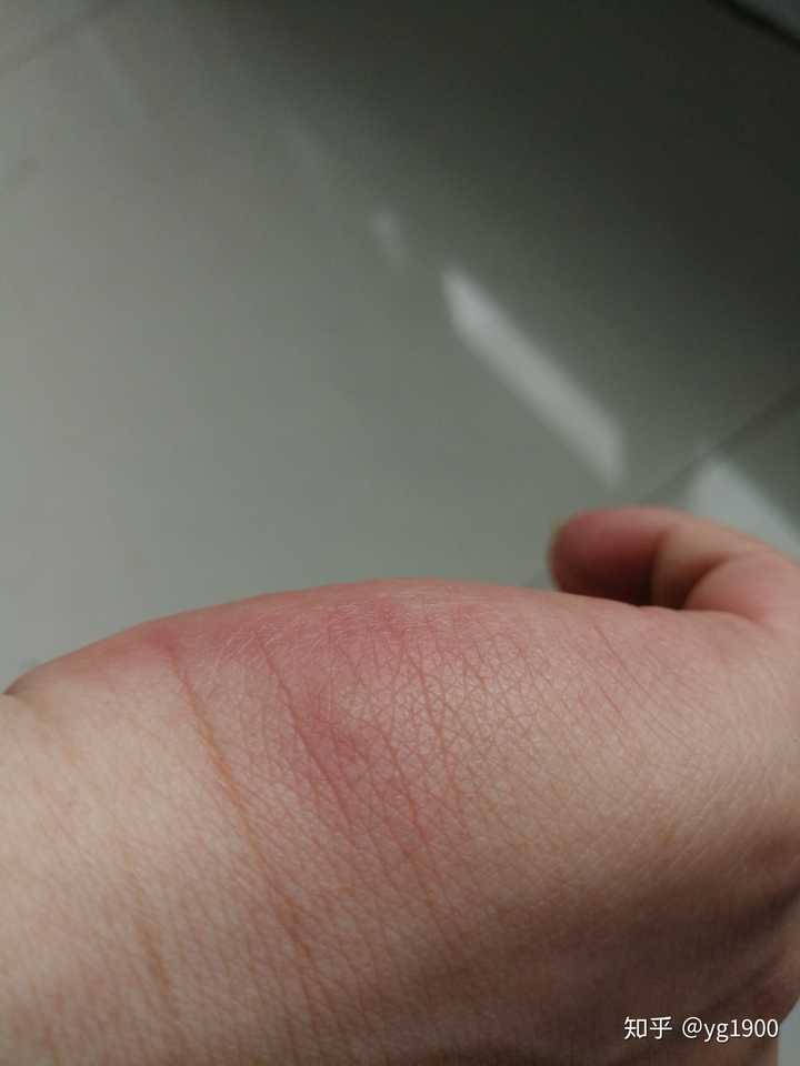 身上长红疙瘩,很痒,像被蚊子咬的,春天 冬天都会长那么一次,这到底是