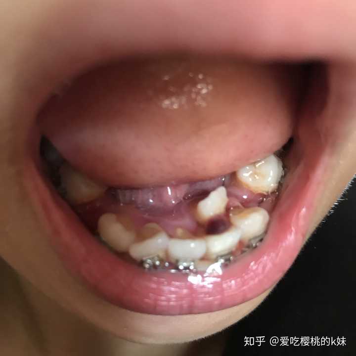 牙龈发黑,是牙缝之间的那个牙龈?
