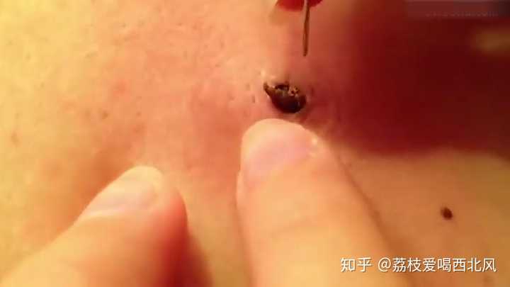 史上最大的黑头有多大