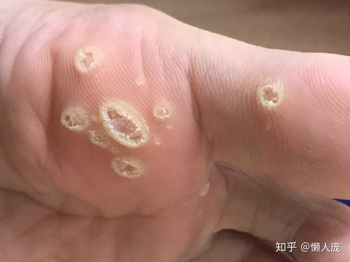 脚上感染长了疣,怎么弄.